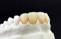 Dental zirconia crowns in the plaster model. White dental veneers on black background. Zirconia bridge and crown with porcelain in