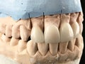 Dental zirconia crowns in the plaster model. White front teeth veneers on diagnostic model on dark background. Closeup of dental