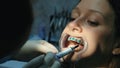 Dentist applies orthodontic blue glue on the teeth to the woman in the latch before installing the bracket system close