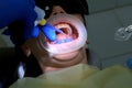 Dentist is applying blue acid on woman& x27;s teeth before installing veneers.