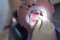 Dentist is applying blue gel on man`s teeth to find dental tartar and caries.