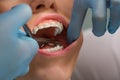 Dentist checking bracket at the braces on the female patient. Close-up. Real People. Royalty Free Stock Photo