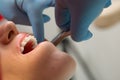 Dentist checking bracket at the braces on the female patient. Close-up. Real People.