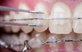 Dentist checking up teeth with ceramic brackets, using reverse tweezers. Macro shot of teeth with braces