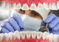 Dentist checkup patient teeth, Inside mouth view Royalty Free Stock Photo