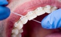 Dentist cleaning teeth with ceramic brackets, using floss at the dental office. Macro shot of teeth with braces Royalty Free Stock Photo
