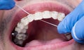 Dentist cleaning teeth with ceramic brackets, using floss at the dental office. Macro shot of teeth with braces Royalty Free Stock Photo