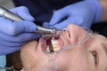 A dentist cleans the patient`s teeth. Preparation of the oral cavity for the installation of braces. Unrecognizable