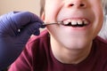 Dentist, doctor examines oral cavity of small patient, molars grow, boy, kid with open mouth, close up of childÃ¢â¬â¢s mouth, teeth