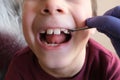 Dentist, doctor examines oral cavity of small patient, molars grow, boy, kid with open mouth, close up of childÃ¢â¬â¢s mouth, teeth