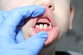 A dentist examines the baby teeth in the boy. The loss of milk teeth