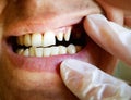 dentist examines a young man sharpened teeth for ceramic crowns or veneers