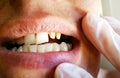 Dentist examines a young man sharpened teeth for ceramic crowns or veneers