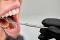 Dentist examining patient's teeth, close up photo, corpped face.