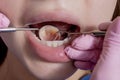 Dentist examining patient teeth with a mouth mirror and dental excavator. Close-up view on the woman Royalty Free Stock Photo