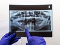 The dentist hand show problem area in the lower jaw bone on a panoramic x-ray of an old person with only a few teeth left in his