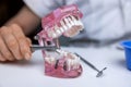 Dentist implantologist showing dental bridge implant technology on human tooth jaw model