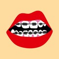Dentist, orthodontist. Braces on your teeth.Open mouth.Dentition with braces, dental braces.Red lips.Vector illustration