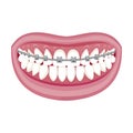 Dentist, orthodontist. Vector illustration. Braces on teeth. open mouth.