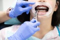 Dentist patient with open mouth and rubber retainer. Braces maintenance procedure