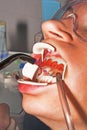 Dentist performs teeth whitening treatment