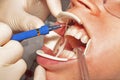 Dentist performs teeth whitening treatment