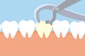 Dentist pulling out a dead tooth with equipment. Dental care activities with a dentist nipper and a dead tooth vector. Dead tooth