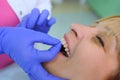 Dentist puts dental veneers patient and correction of teeth Royalty Free Stock Photo