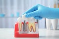 Dentist putting crown onto abutment of dental implant between teeth at table indoors, closeup