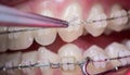 Dentist treating teeth with ceramic brackets, using mosquito at the dental office. Macro shot of teeth with braces Royalty Free Stock Photo