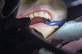 dentist uses a special instrument to restore a tooth.