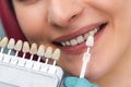 Dentist using shade guide at beautiful smile of woman mouth to check the process of teeth whitening or shades of the implants Royalty Free Stock Photo