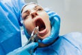 Dentist using surgical pliers to remove a decaying tooth.