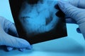 Dentistlooking teeth on x-ray, wisdom tooth Royalty Free Stock Photo