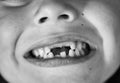 Dentistry. Child with missing teeth