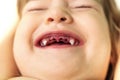 Dentistry. Close-up of a beautiful little girl lying down and showing her mouth with her baby teeth removed. Child after tooth ext
