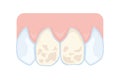 Dentistry: Damaged enamel of the front teeth. Dental problems. Vector illustration for teaching materials on dentistry