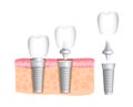 Dentistry. Dentistry. Realistic dental implant structure with all parts: crown, abutment, screw. Implantation of human teeth. Vect