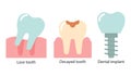 Dentistry icons set, teeth icons, pulled out tooth, spoiled tooth and implant. Flat illustration