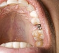 Dentistry implant