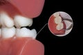 Dentistry surgery extraction tooth