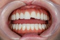 Dentistry of teeth before treatment. Close-up photo of teeth. Image of teeth whitening. Treatment plan for a new smile. Making