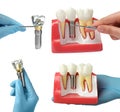 Dentists showing educational models of dental implants on white background, closeup. Collage Royalty Free Stock Photo