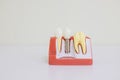 Dentsts dental prosthetic teeth, gums, roots teaching student model with titanium metal implant.tooth model Royalty Free Stock Photo