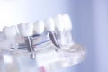 Dentsts dental tooth implant Royalty Free Stock Photo