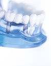 Dentsts dental tooth implant Royalty Free Stock Photo