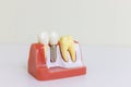 Dentsts dental prosthetic teeth, gums, roots teaching student model with titanium metal implant.tooth model Royalty Free Stock Photo