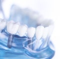 Dentsts dental tooth implant Royalty Free Stock Photo