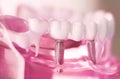 Dentsts dental tooth implant Royalty Free Stock Photo