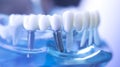 Dentsts dental tooth implant Royalty Free Stock Photo